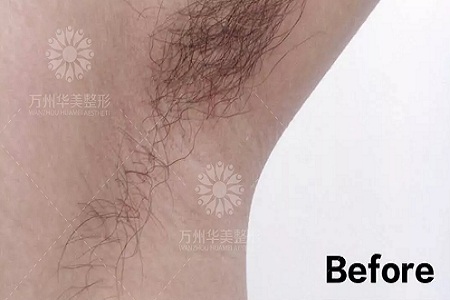 萬人脫毛節(jié)丨脫毛到底要幾次才能脫干凈呢？