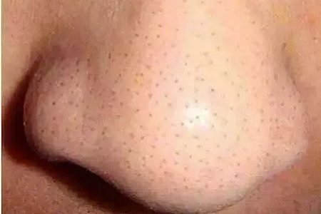 你知道臉上的黑頭和白頭是怎么形成的嗎？