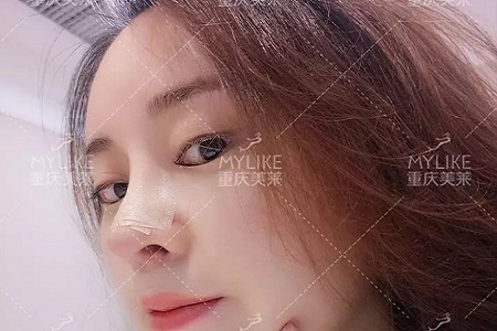 “鼻綜合”后假又歪，還攣縮？鼻修復(fù)還原自然生態(tài)美鼻