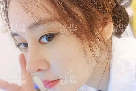 “鼻綜合”后假又歪，還攣縮？鼻修復(fù)還原自然生態(tài)美鼻