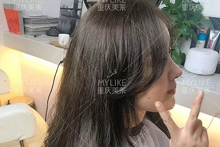 “鼻綜合”后假又歪，還攣縮？鼻修復(fù)還原自然生態(tài)美鼻