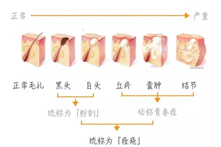 擠痘竟然被送進(jìn)ICU！你的痘痘還好嗎？