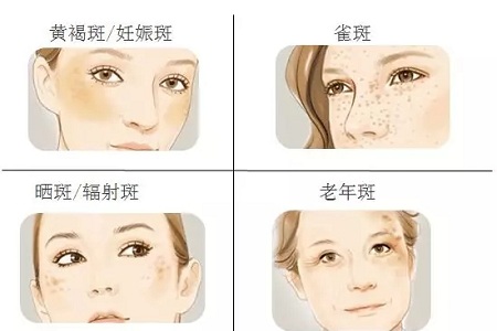 祛斑偏方“害死人”，小仙女們可長點心吧！