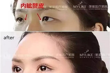 推薦這幾種增大眼睛的方法，除了開(kāi)外眼角！