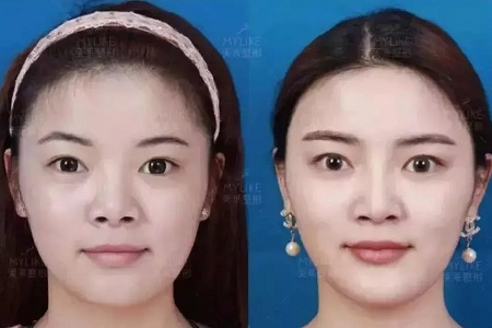 推薦這幾種增大眼睛的方法，除了開(kāi)外眼角！