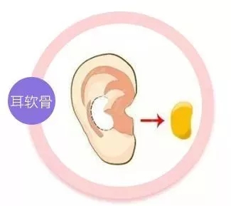 擔(dān)心鼻整形假體透光、發(fā)紅、移位？了解下自體軟骨