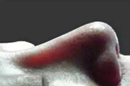 擔(dān)心鼻整形假體透光、發(fā)紅、移位？了解下自體軟骨