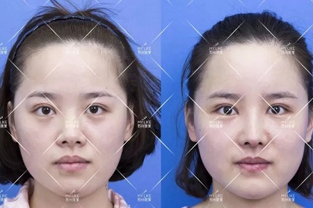 擔(dān)心鼻整形假體透光、發(fā)紅、移位？了解下自體軟骨