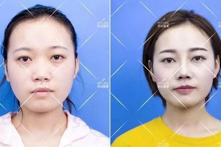 擔(dān)心鼻整形假體透光、發(fā)紅、移位？了解下自體軟骨
