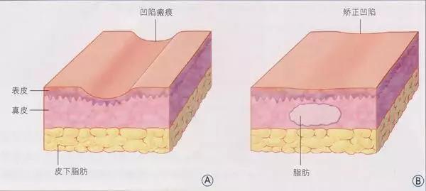 自體脂肪填充為什么需要二次補(bǔ)打？