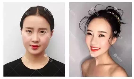 能瘦臉，又能除皺的瘦臉針，了解一下！