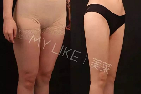 瘦身Flag挑戰(zhàn)賽 | “躺著就能瘦”真的不是夢，人人都可以！