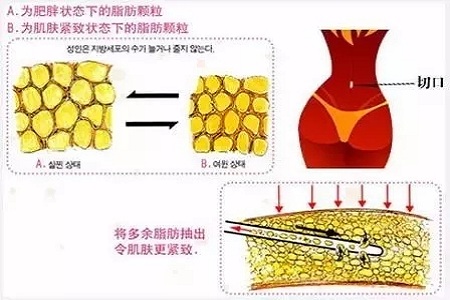 吸脂，怎樣做才算是剛剛好？