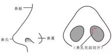 隆鼻手術(shù)切口在哪里？才能自然不留疤