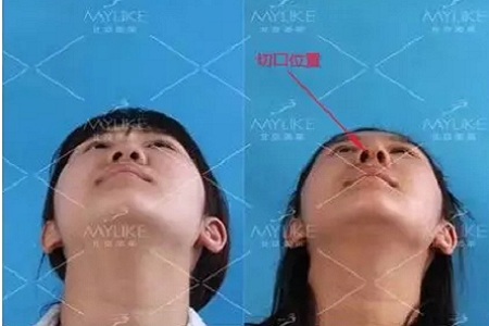 隆鼻手術(shù)切口在哪里？才能自然不留疤