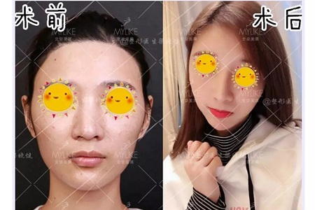 隆鼻手術(shù)切口在哪里？才能自然不留疤