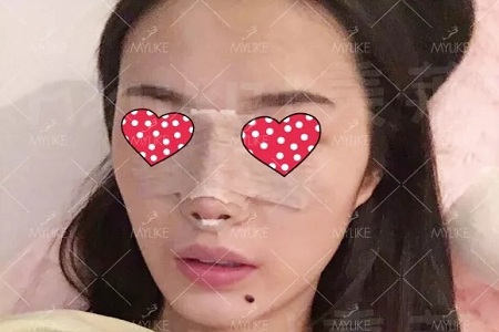 顏值：隆了個鼻子，男朋友說像換了一個女朋友