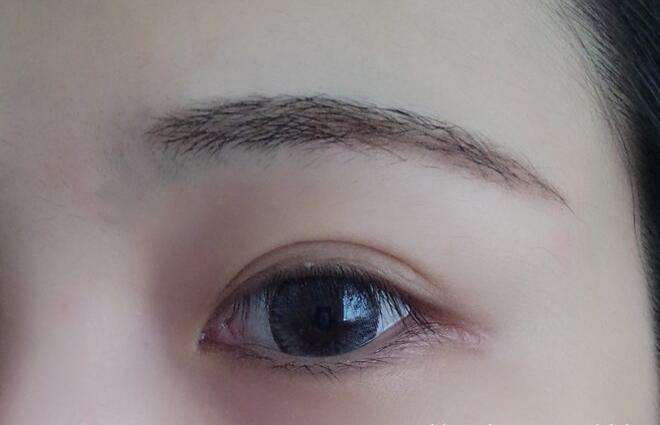 雙眼皮手術(shù)要多少錢(qián)？