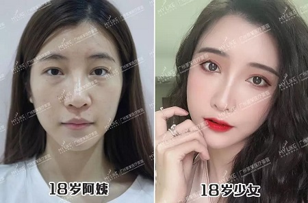 填脂肪21天，老媽竟阻止我相親！why？