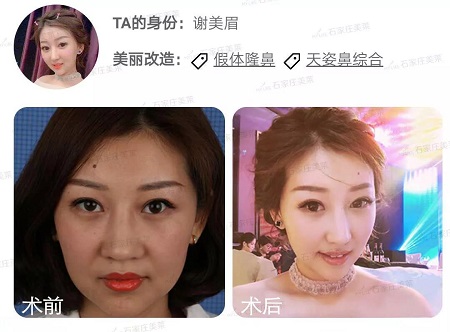 做了假體隆鼻后，變化有多大！看4個案例對比