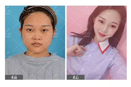 顏值：鼻子的改變能讓一個(gè)女孩變化有多大？
