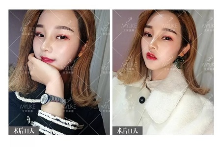 顏值：鼻子的改變能讓一個(gè)女孩變化有多大？