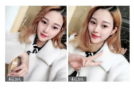 顏值：鼻子的改變能讓一個(gè)女孩變化有多大？
