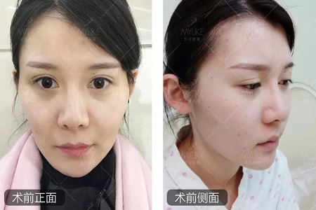 顏值：做完自體脂肪填充15天后，她變啥樣了？