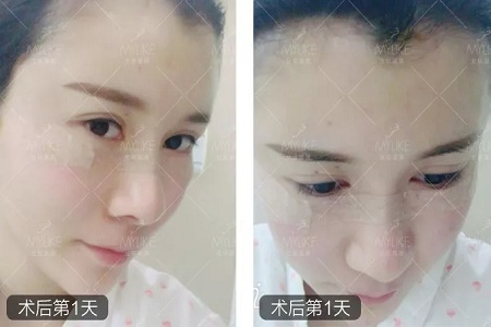 顏值：做完自體脂肪填充15天后，她變啥樣了？