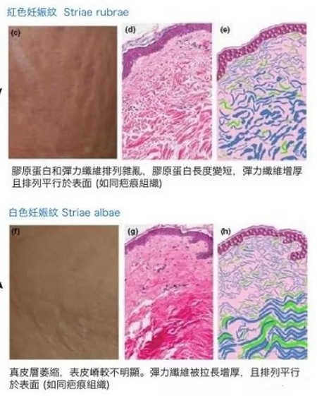 為什么瘦人也會有“肥胖紋”？