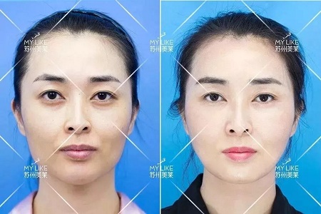 你討厭的脂肪，用在臉上就是寶貝！