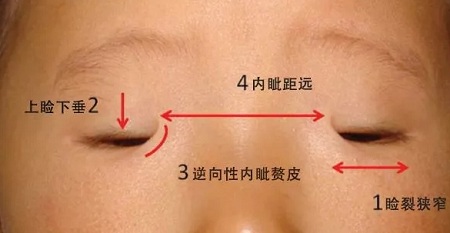 開眼角和不開眼角，差距有多大？