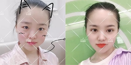 開眼角和不開眼角，差距有多大？