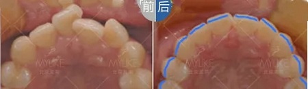 醫(yī)美白皮書：顏值爆表，全靠隱形牙套矯正！