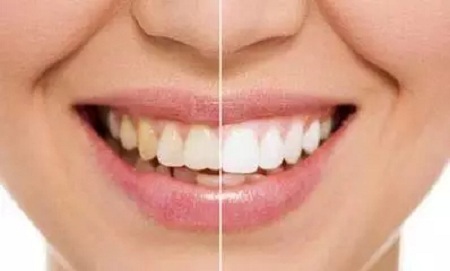牙齒發(fā)黃怎么辦？還有救嗎？