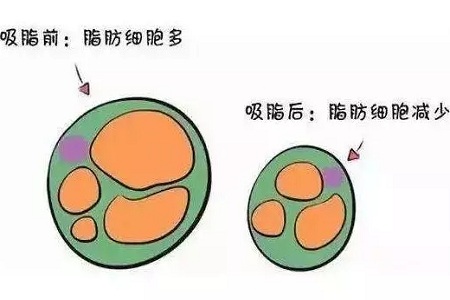 關(guān)于吸脂那些不能說的秘密，今天要在這里一次說完！
