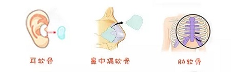 糾結(jié)！鼻頭太圓想塑形是用肋軟骨還是耳軟骨好？