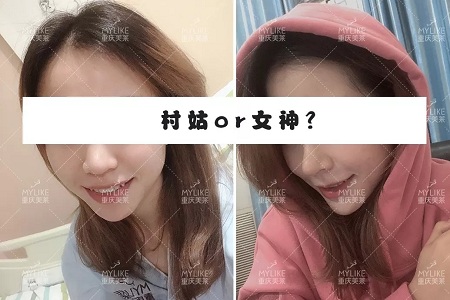 糾結(jié)！鼻頭太圓想塑形是用肋軟骨還是耳軟骨好？