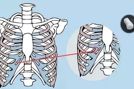 糾結(jié)！鼻頭太圓想塑形是用肋軟骨還是耳軟骨好？