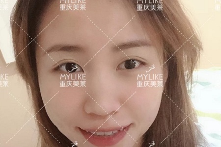 糾結(jié)！鼻頭太圓想塑形是用肋軟骨還是耳軟骨好？