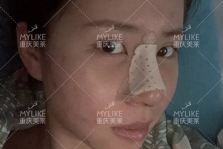 糾結(jié)！鼻頭太圓想塑形是用肋軟骨還是耳軟骨好？