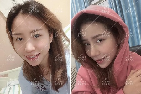 糾結(jié)！鼻頭太圓想塑形是用肋軟骨還是耳軟骨好？