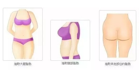 讓明星“一夜回春”的自體脂肪到底適不適合你？