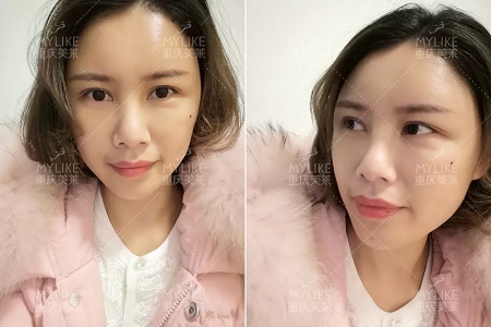 讓明星“一夜回春”的自體脂肪到底適不適合你？