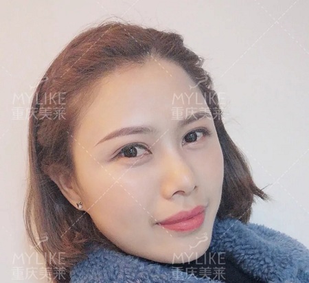 讓明星“一夜回春”的自體脂肪到底適不適合你？