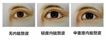 雙眼皮+開眼角為什么是較佳拍檔，一分鐘帶你看懂！