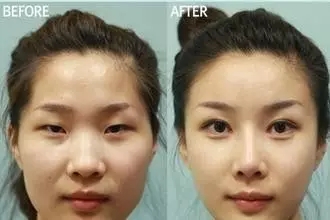 雙眼皮+開眼角為什么是較佳拍檔，一分鐘帶你看懂！