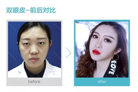 做了雙眼皮，醫(yī)師為什么建議要多睜眼？
