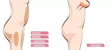 自體脂肪or假體隆胸，我到底應(yīng)該怎么選？