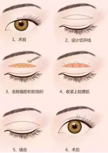 問診室：做雙眼皮前，這些問題你需要提前了解！